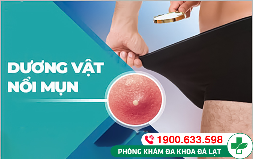 DƯƠNG VẬT NỔI MỤN MỦ - CẢNH BÁO NHIỀU BỆNH XÃ HỘI NGUY HIỂM